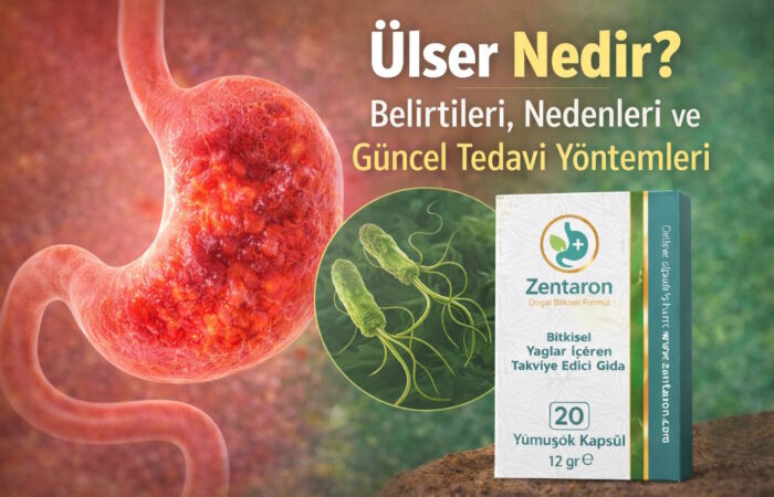 Ülser Nedir? Belirtileri, Nedenleri ve Güncel Tedavi Yöntemleri